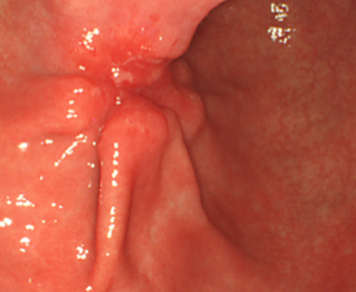 Gastric carcinoma picture