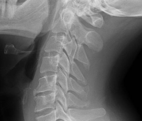 Immagine a raggi X del midollo spinale.