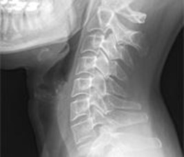 Рентгенівське зображення спинного мозку та щелепи.